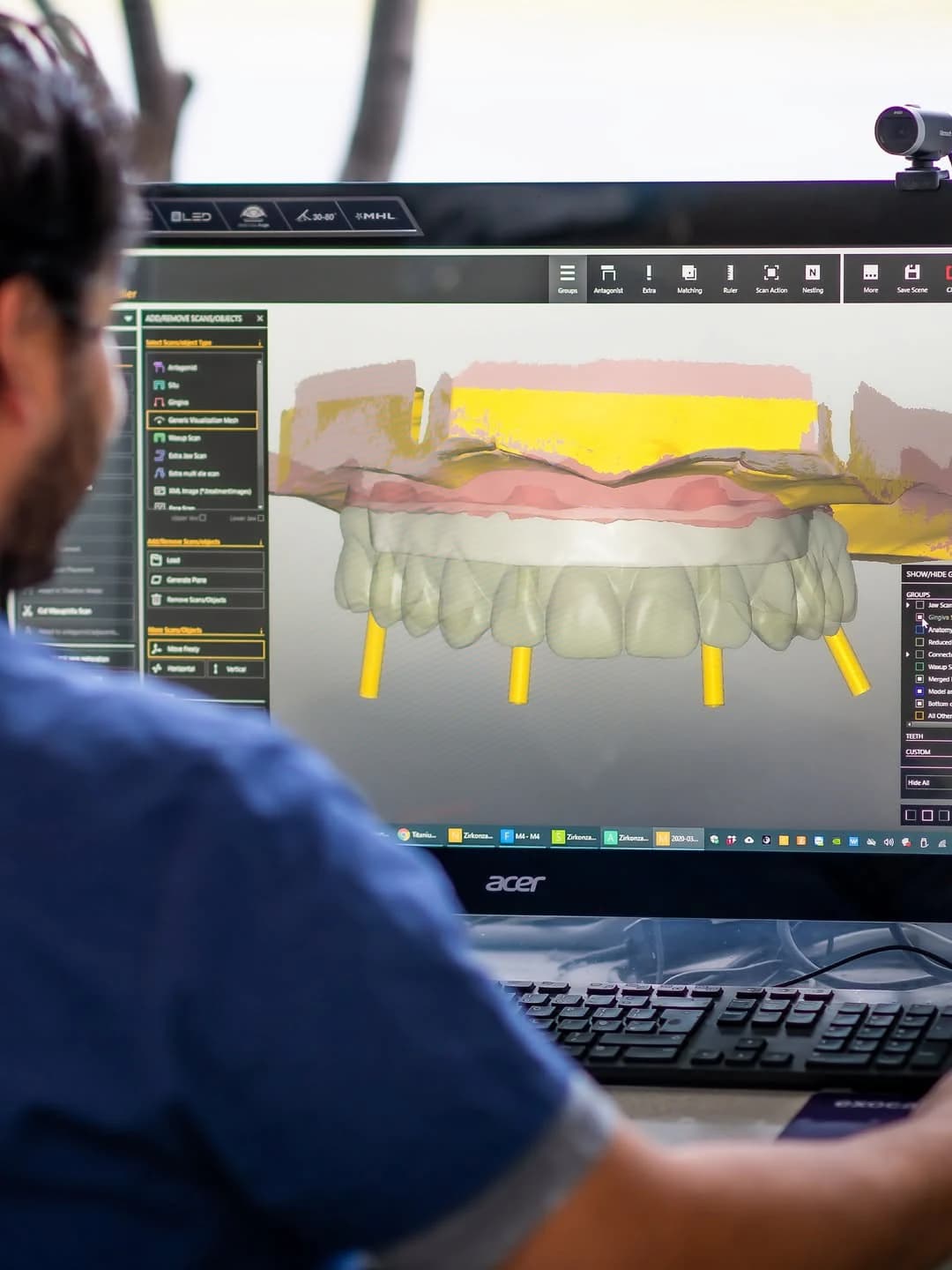 Digital smile design being refined in prosthetic-design software