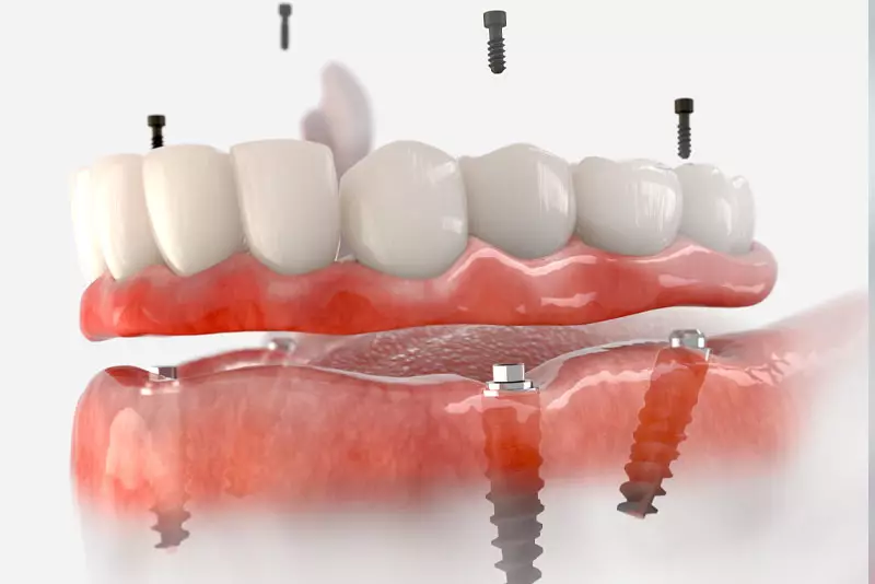 Modelo de arcada completa que muestra seis implantes sosteniendo dientes fijos