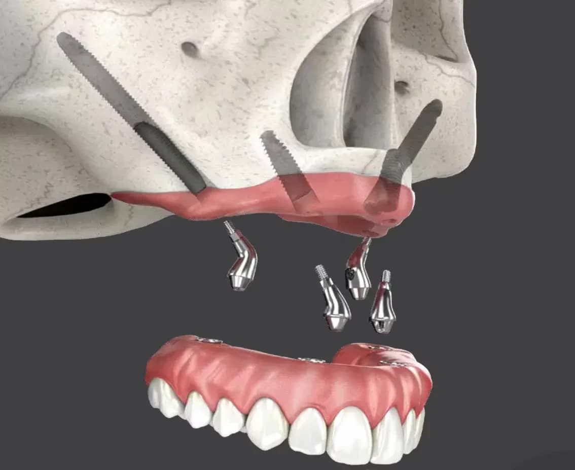 Illustration of zygomatic implants anchored in the cheekbone above a resorbed upper jaw