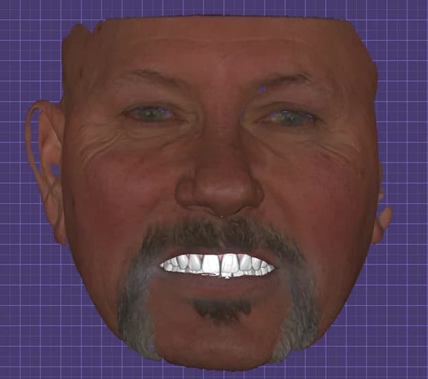 Exploración facial tridimensional mostrada en el software de planificación de implantes