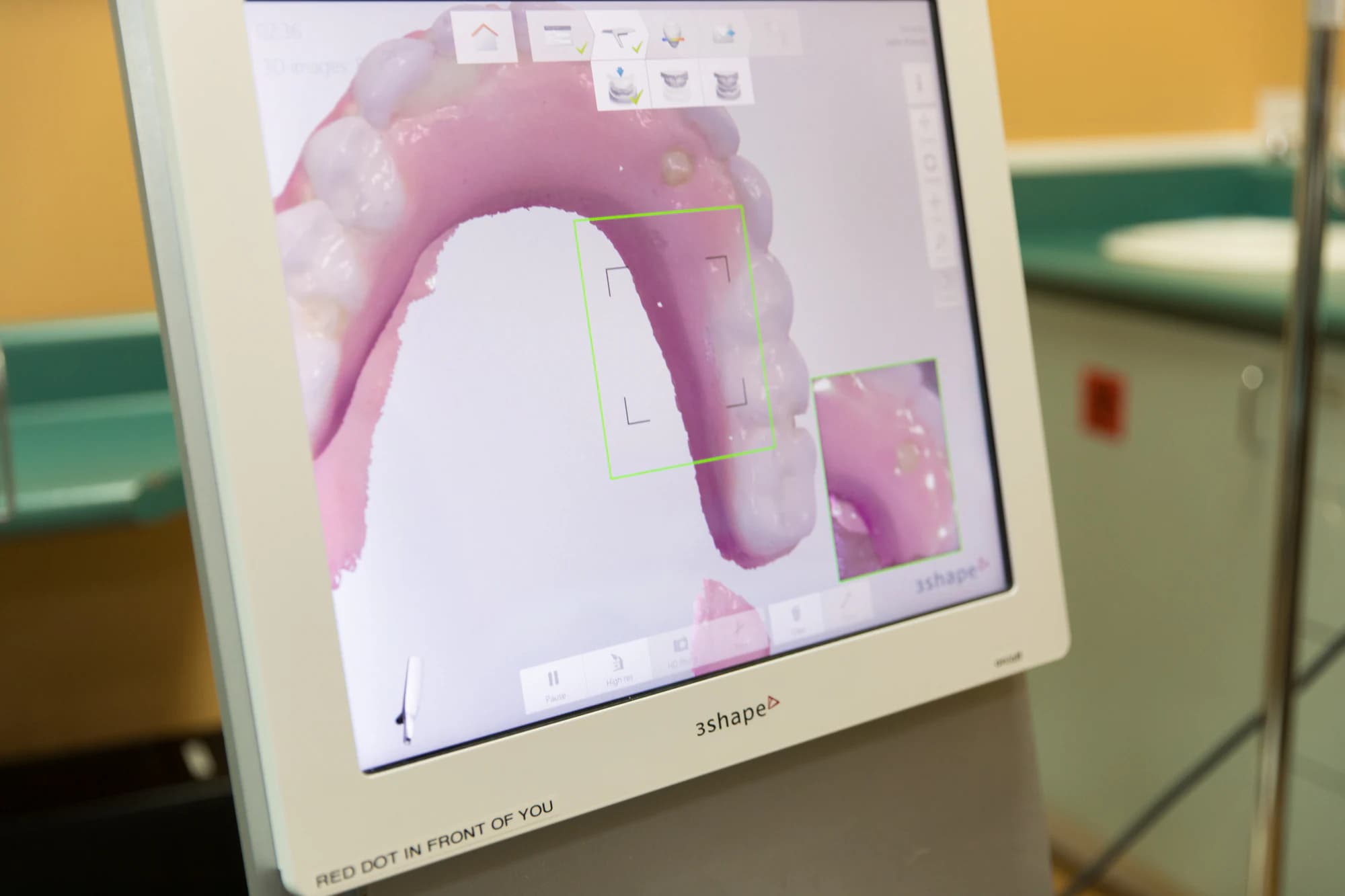 An implant plan laid out over a 3D scan