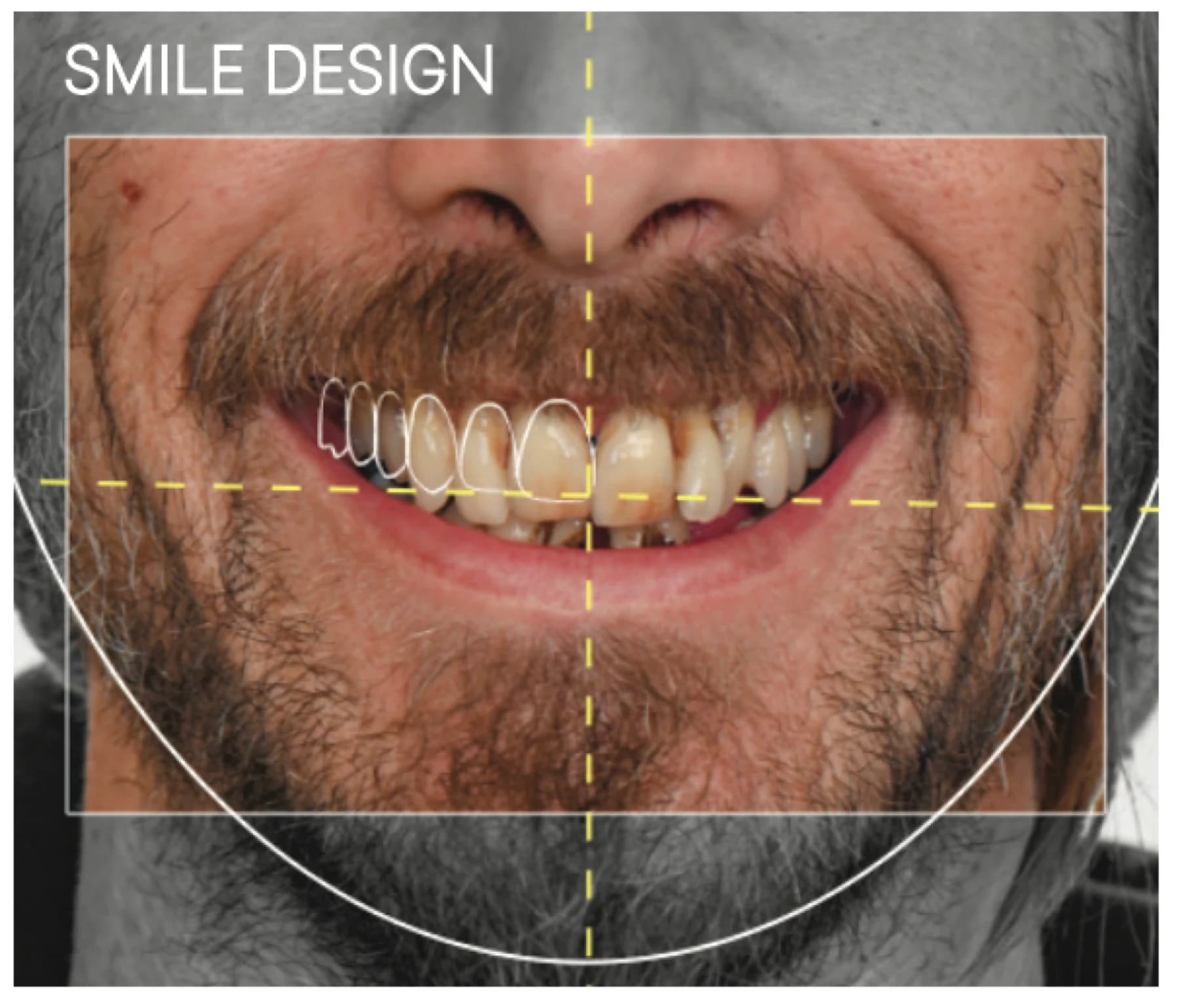 A smile design overlay with outlines of new front teeth and midline guides drawn over a patient's smile