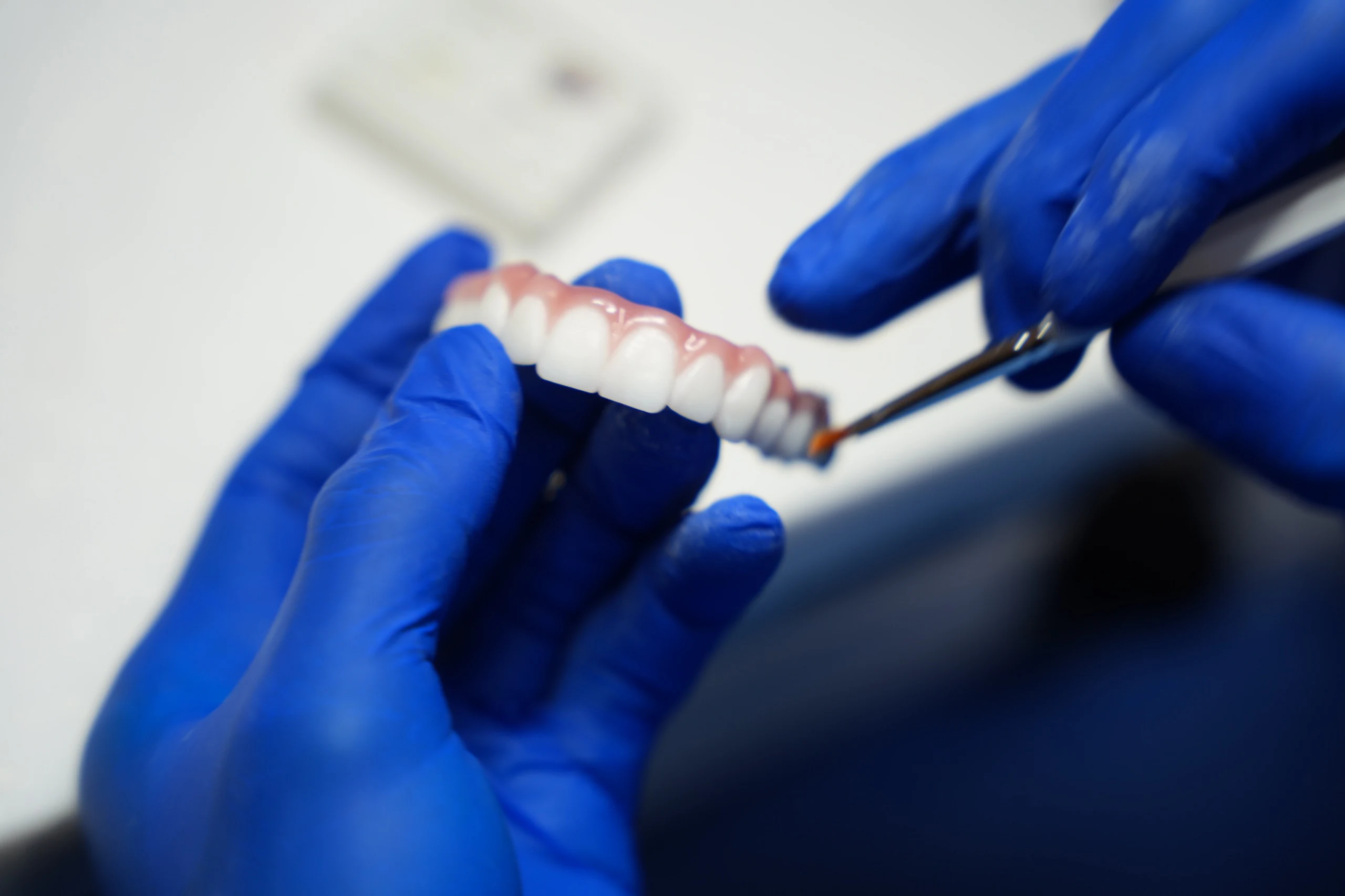 Panghuling adjustment sa implant bridge bago ito ikabit