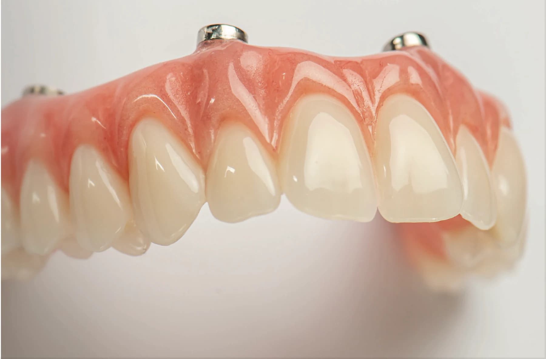 Close-up of a fixed full-arch implant prosthesis