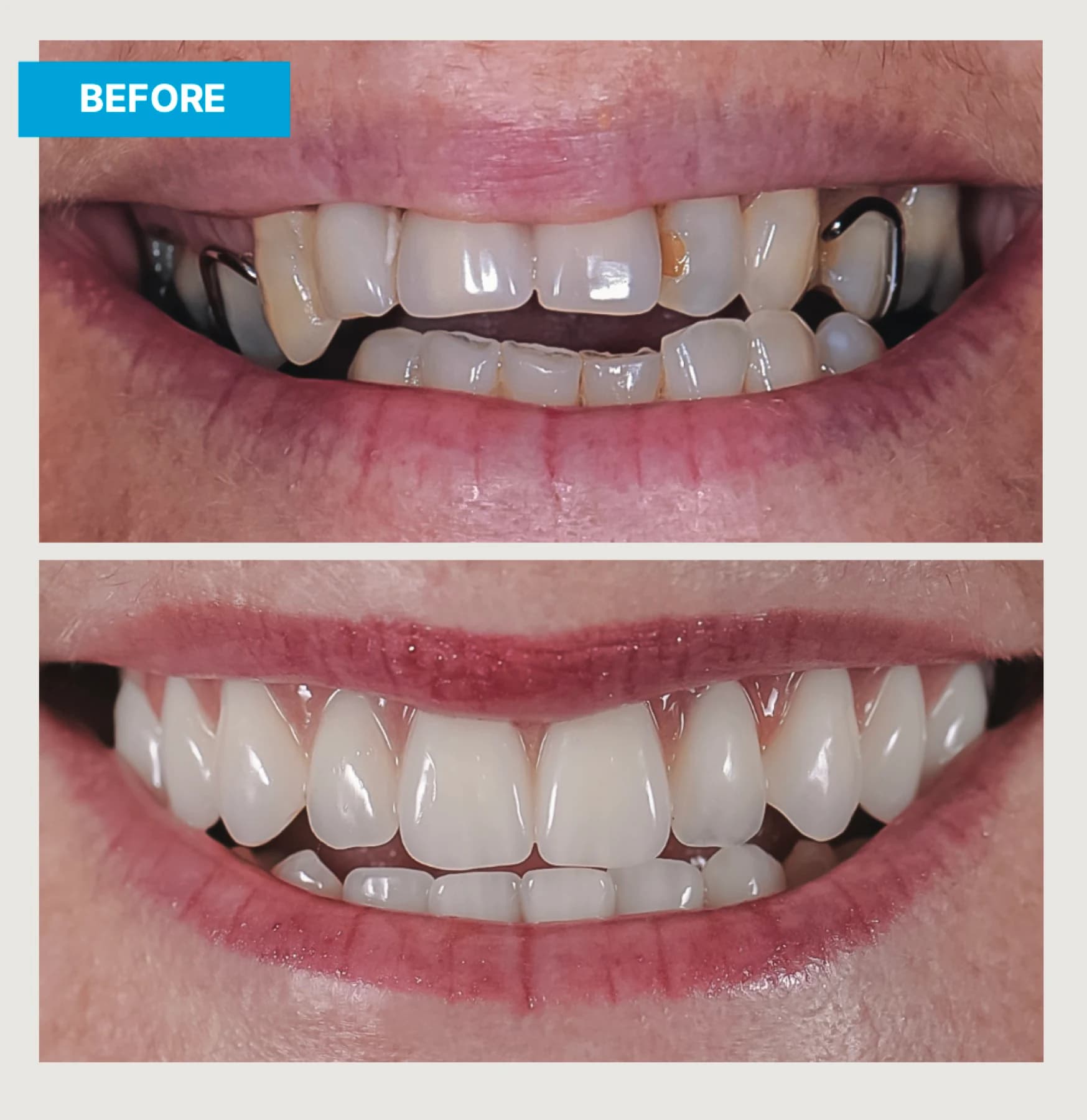 Vistas de antes y después de una rehabilitación de boca completa con implantes