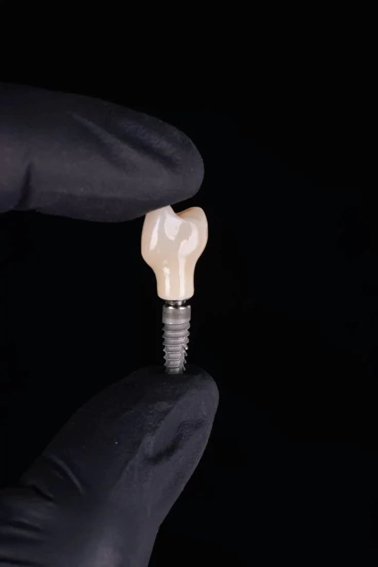 Una mano enguantada sosteniendo una corona unitaria sobre implante
