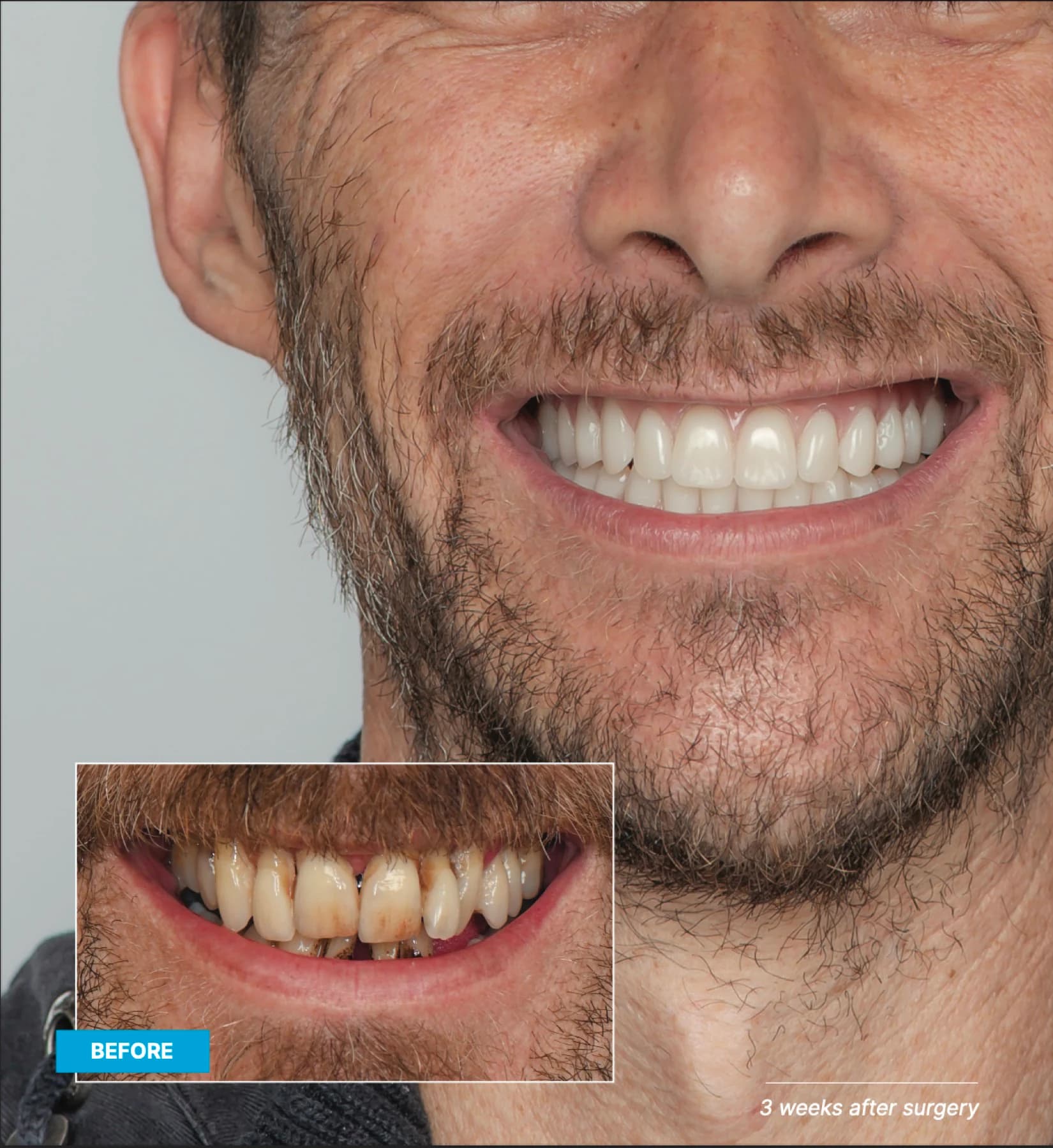 Before-and-after views of an implant smile design