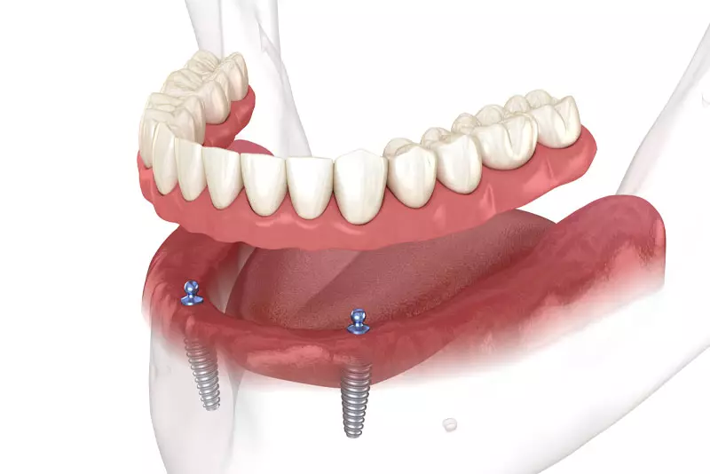 Model of an implant-supported snap-in denture