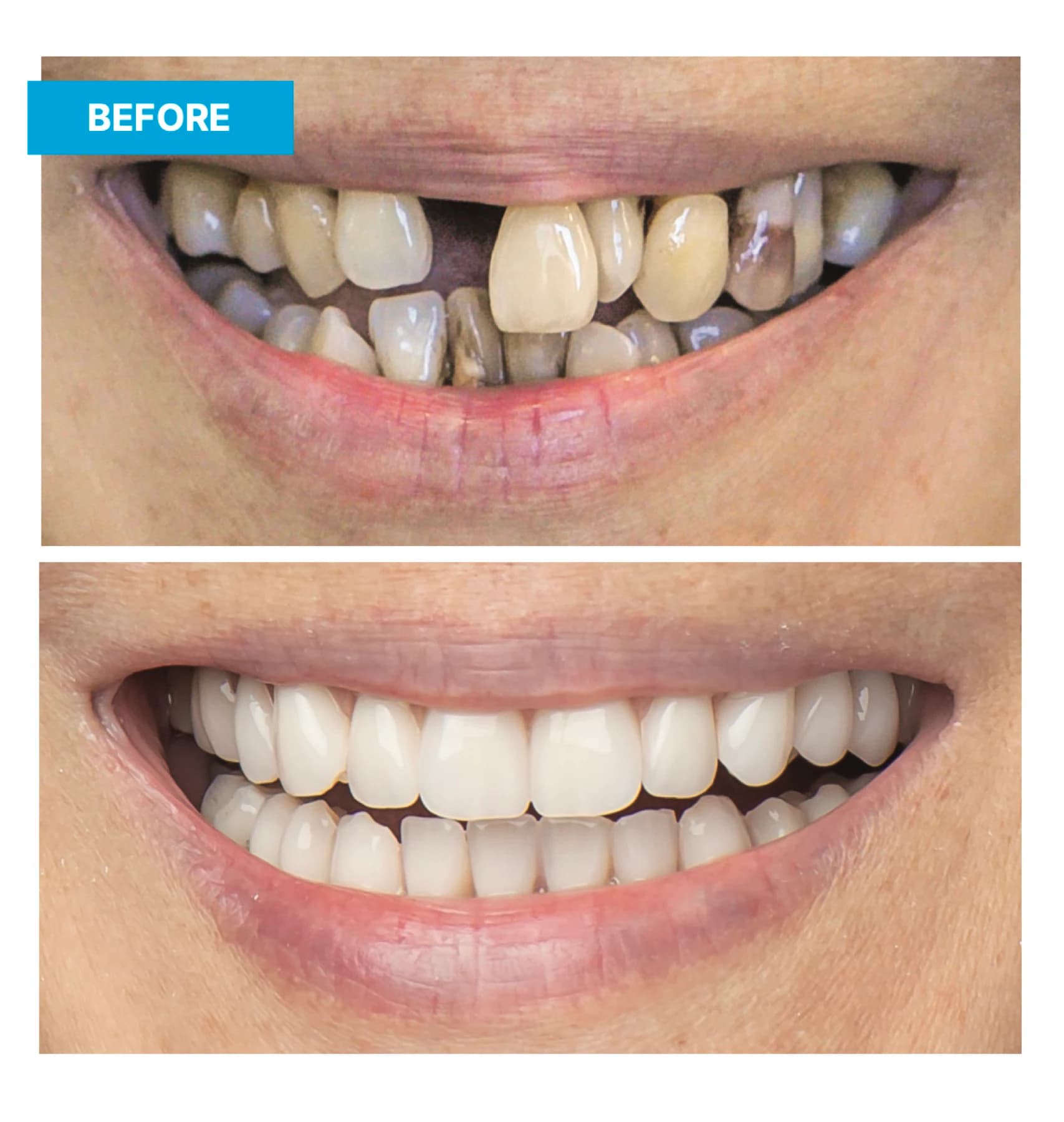 Before-and-after views of an implant-supported smile restoration