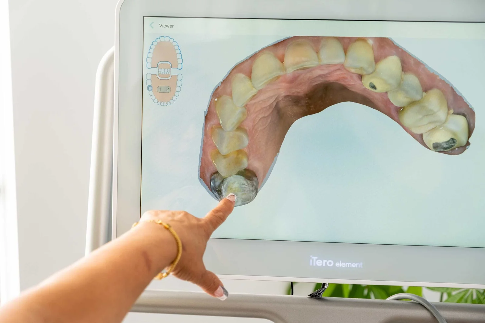 An intraoral scan on the operatory screen