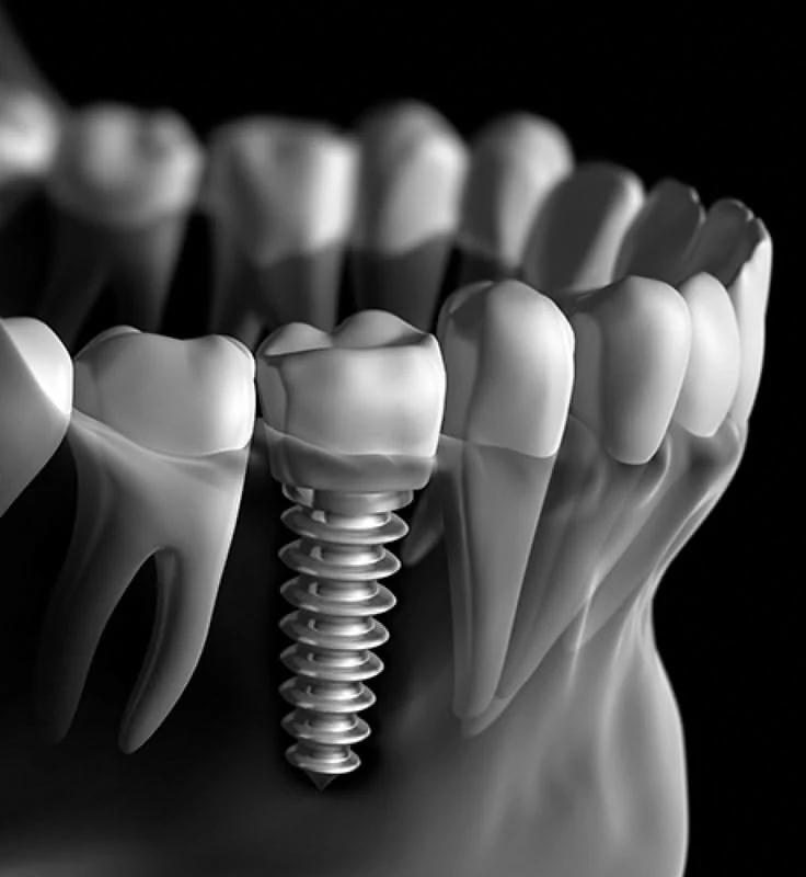 Cutaway rendering of a single dental implant supporting a ceramic crown