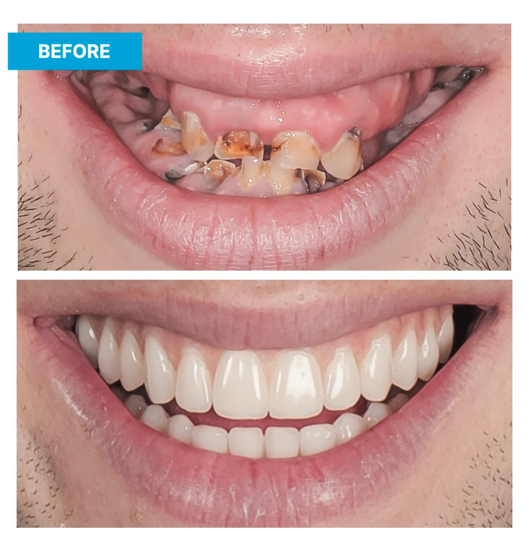 Before-and-after views of an upper-arch implant restoration