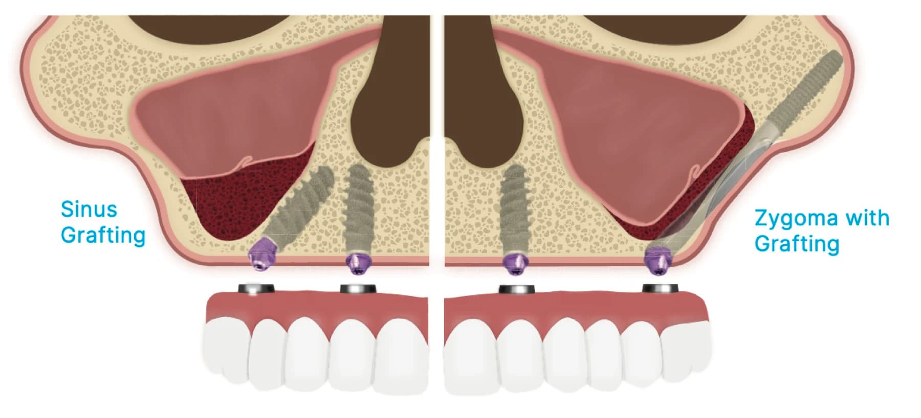 Diagram comparing a zygomatic implant pathway with sinus grafting