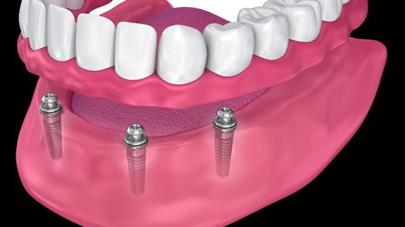 Dental Implants Vs Dentures Fremont, CA