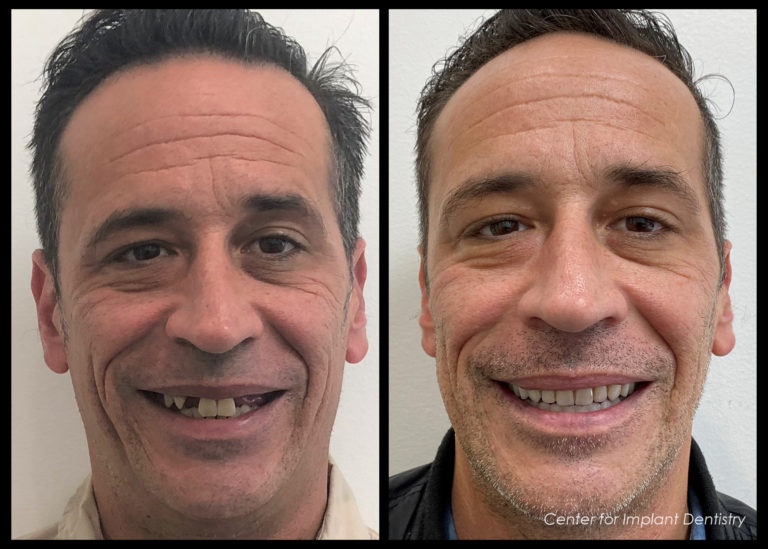 full-face-before-and-after10