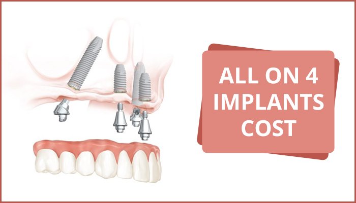 cheap all on 4 dental implants