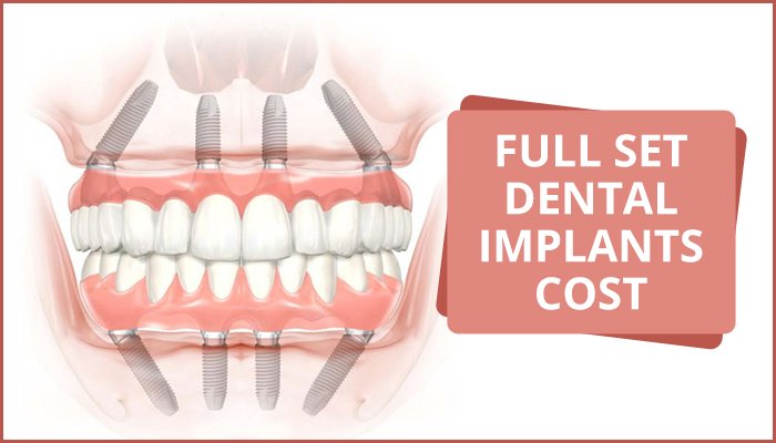 Cost Of Full Set Dental Implant Center For Implant Dentistry   Blog All On 4 2 1 