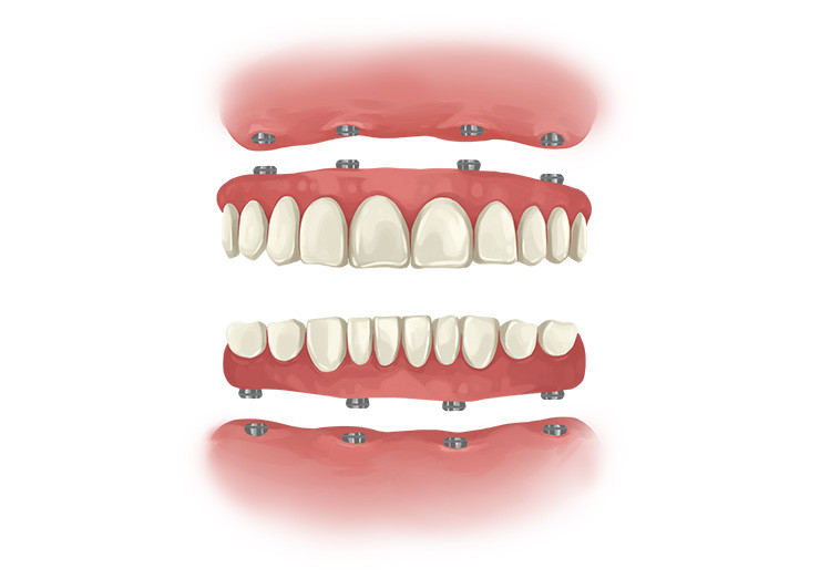 Dental Implants Full teeth implants
