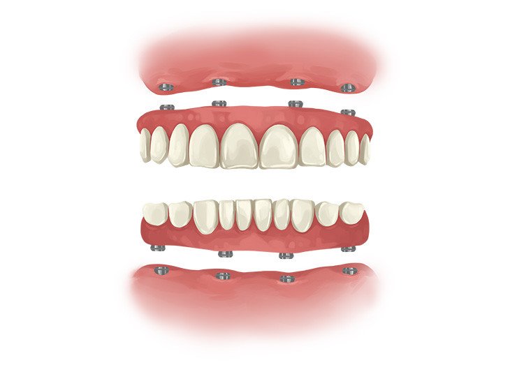 Dental Implants Full teeth implants 
