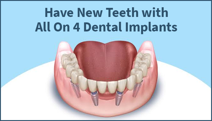 New Teeth With All on 4 Dental Implants