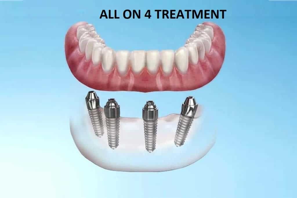 What are full mouth dental implants and their advantages?