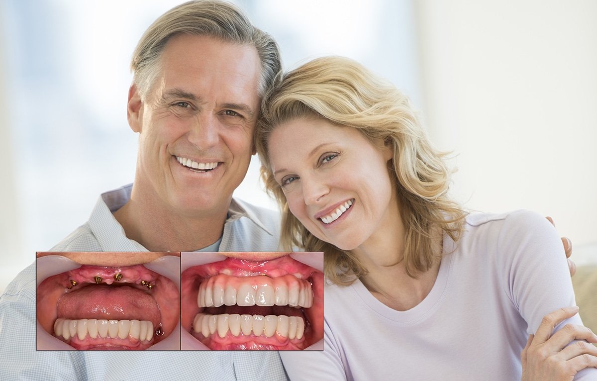 Full Mouth Dental implants - CID