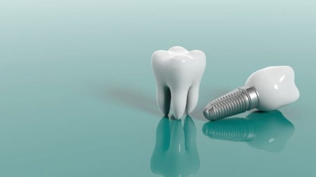 Dental implants