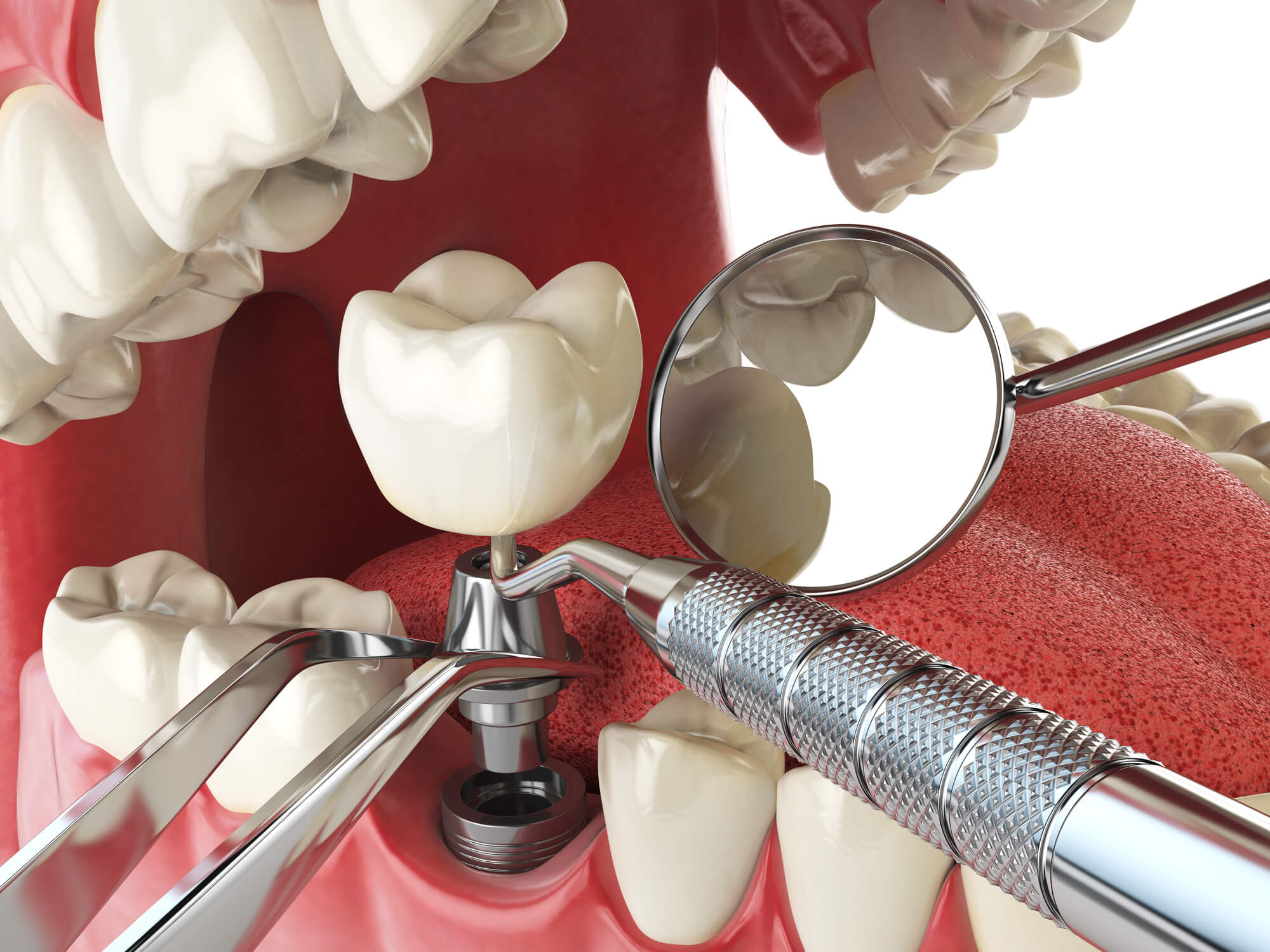 3d image of dental implants