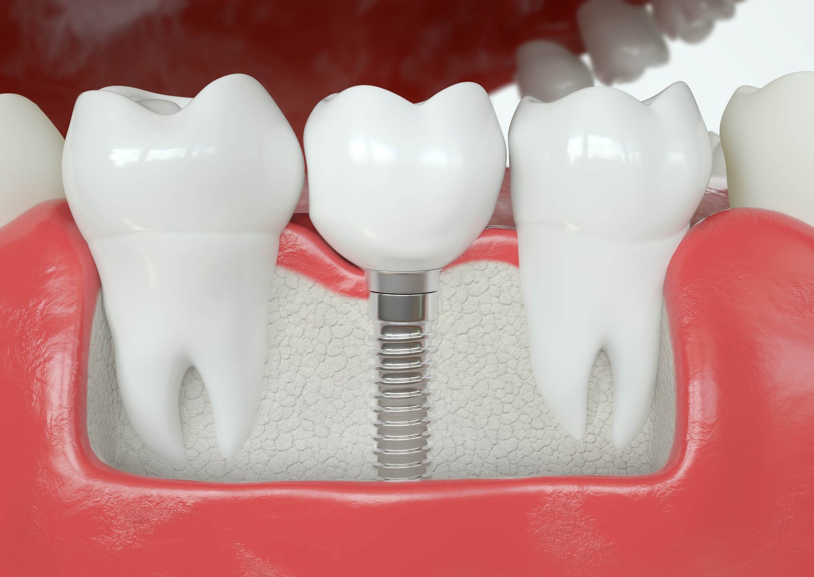 a model of Affordable Dental Implants in San Francisco