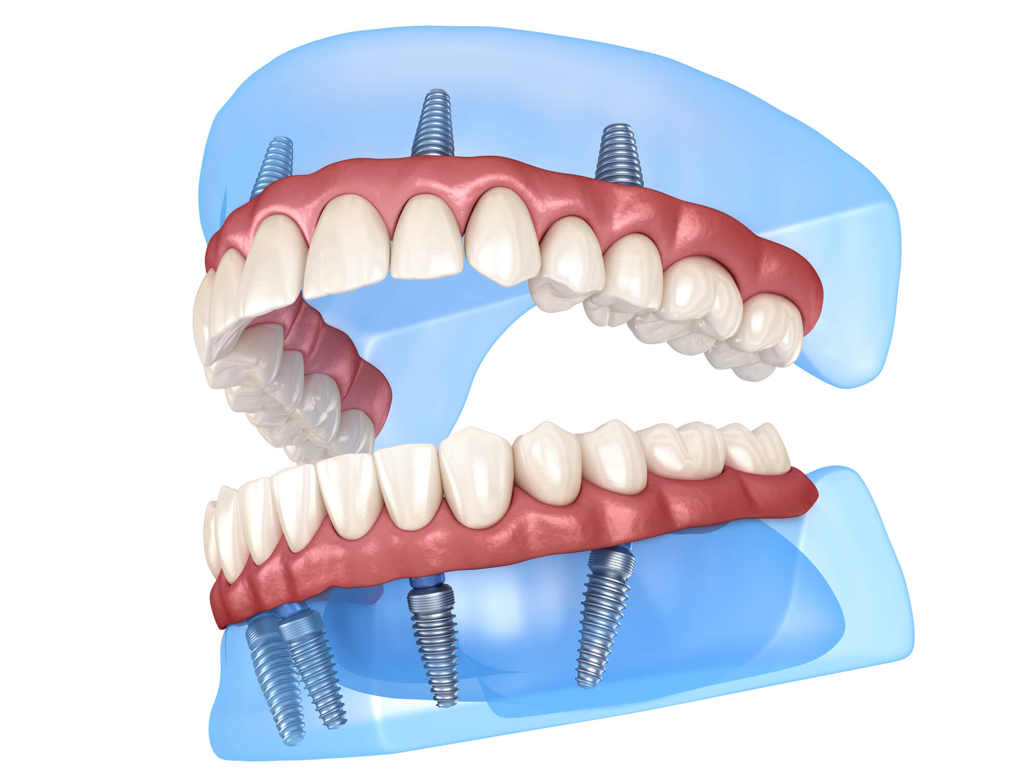 3D view of all on 4 dental implants