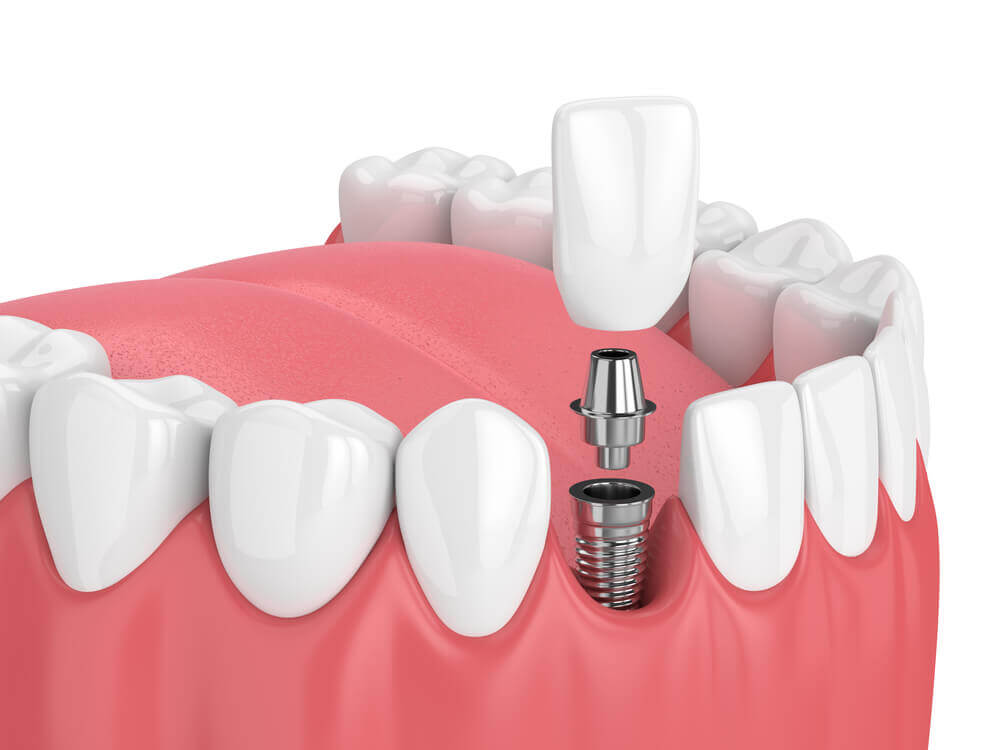 A sample of dental implants with dental implant specialist .
