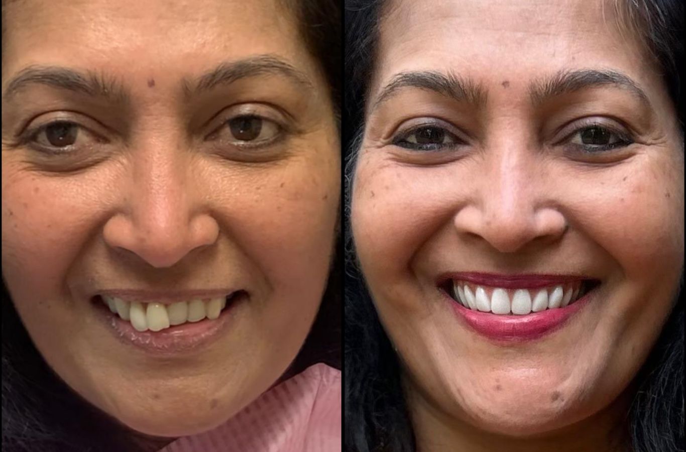 A happy patient receiving top-quality dental implants in Oakland, CA, demonstrating the advantages of permanent tooth replacement.