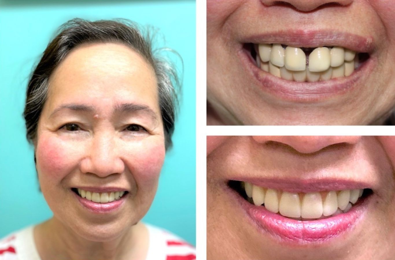 A patient receiving top-quality dental implants in Pleasanton, CA, demonstrating the long-term advantages of permanent tooth replacement.