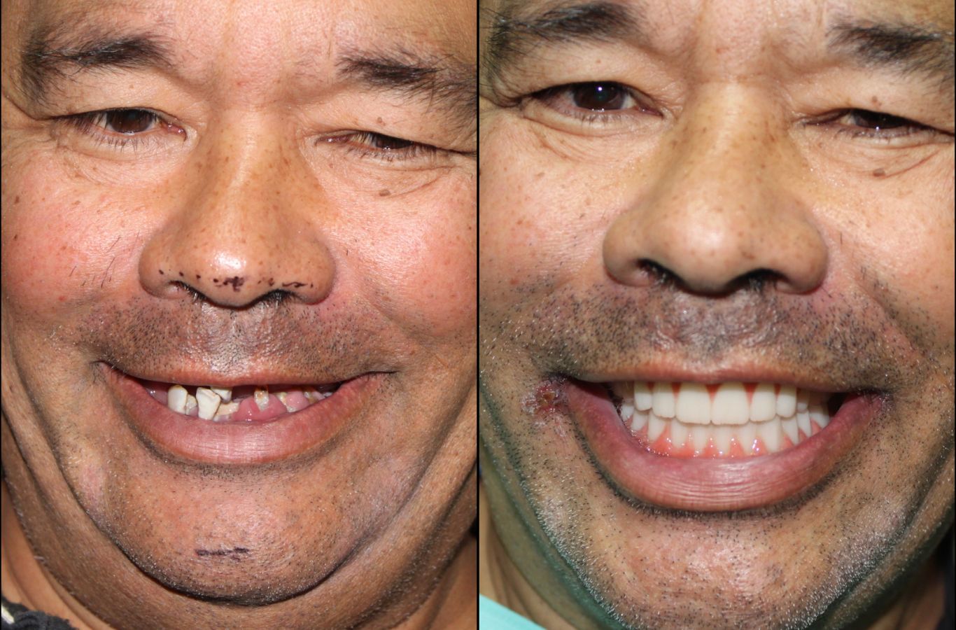 A satisfied patient receiving expert dental implant care at Center For Implant Dentistry in Sunnyvale, CA, highlighting the benefits of a permanent solution.