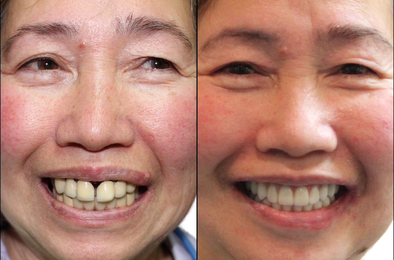 A specialist at Center For Implant Dentistry performing a dental implant procedure in Sunnyvale, CA, ensuring precision and patient comfort.