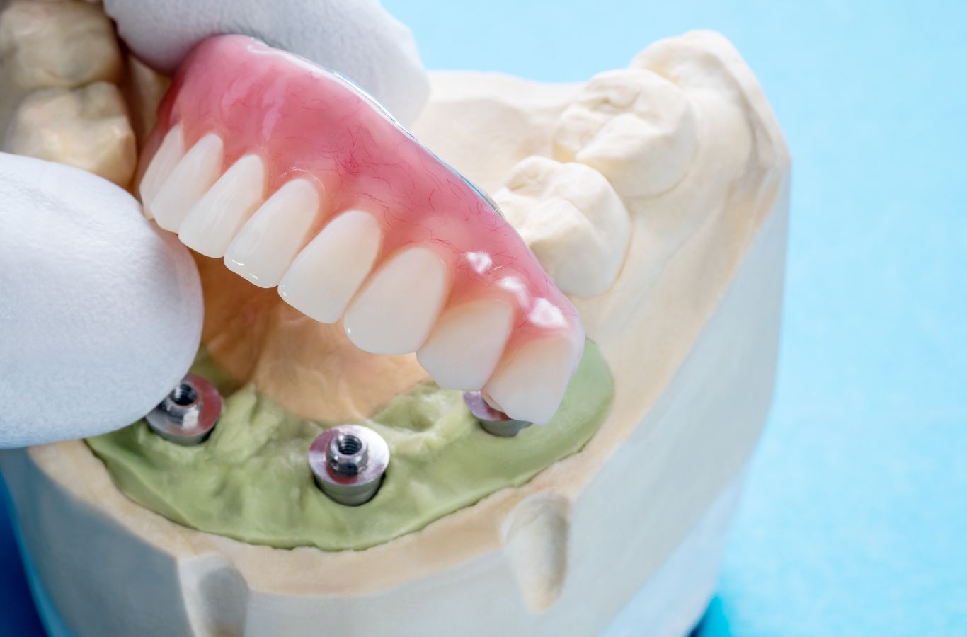 Full Mouth Dental Implants