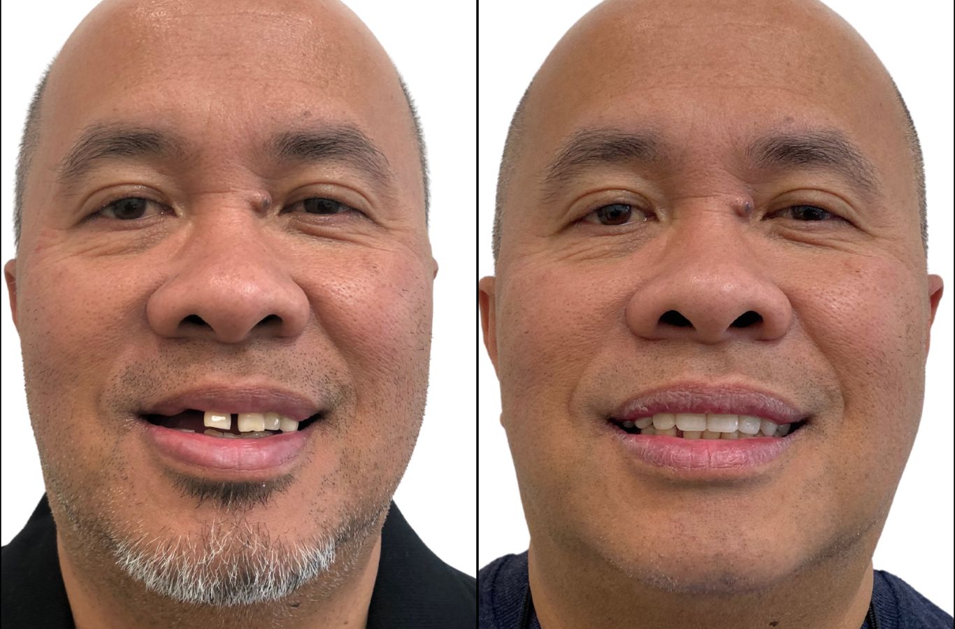 A patient’s before and after transformation with full mouth dental implants at Center For Implant Dentistry in Oakland, CA, showcasing a confident, restored smile.