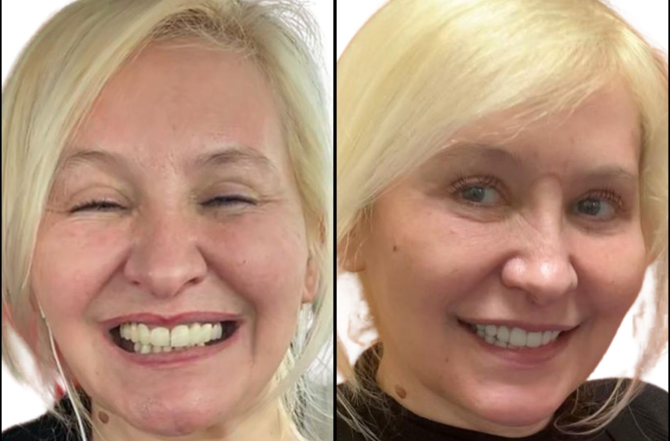 A patient’s before and after transformation with full mouth dental implants at Center For Implant Dentistry in Pleasanton, CA, showing a confident, restored smile.