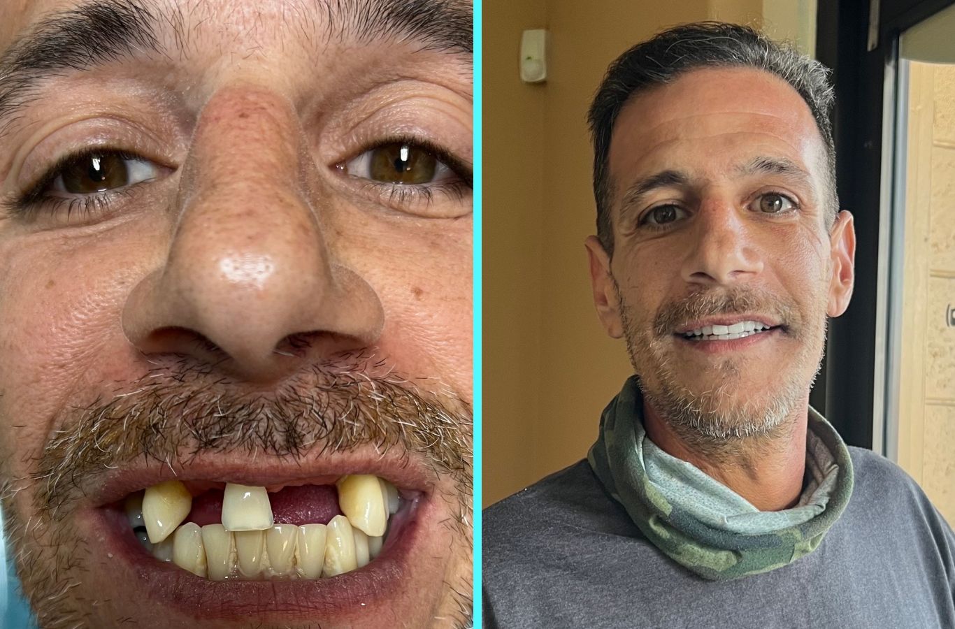 A patient’s before and after transformation with full mouth dental implants at Center For Implant Dentistry in Sunnyvale, CA, showcasing a restored, confident smile.