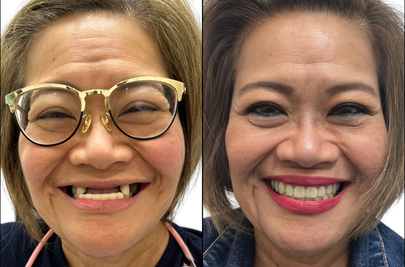 A patient’s before and after transformation with full mouth dental implants at Center For Implant Dentistry in Walnut Creek, CA, showing a fully restored smile.