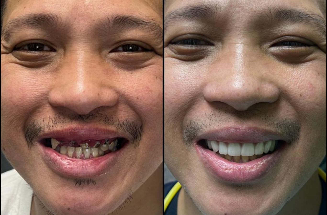 Benefits of Full Mouth Dental Implants in Ukiah, CA by Center For Implant Dentistry A Center For Implant Dentistry team member performing full mouth dental implant work in Ukiah, CA, emphasizing long-term benefits.