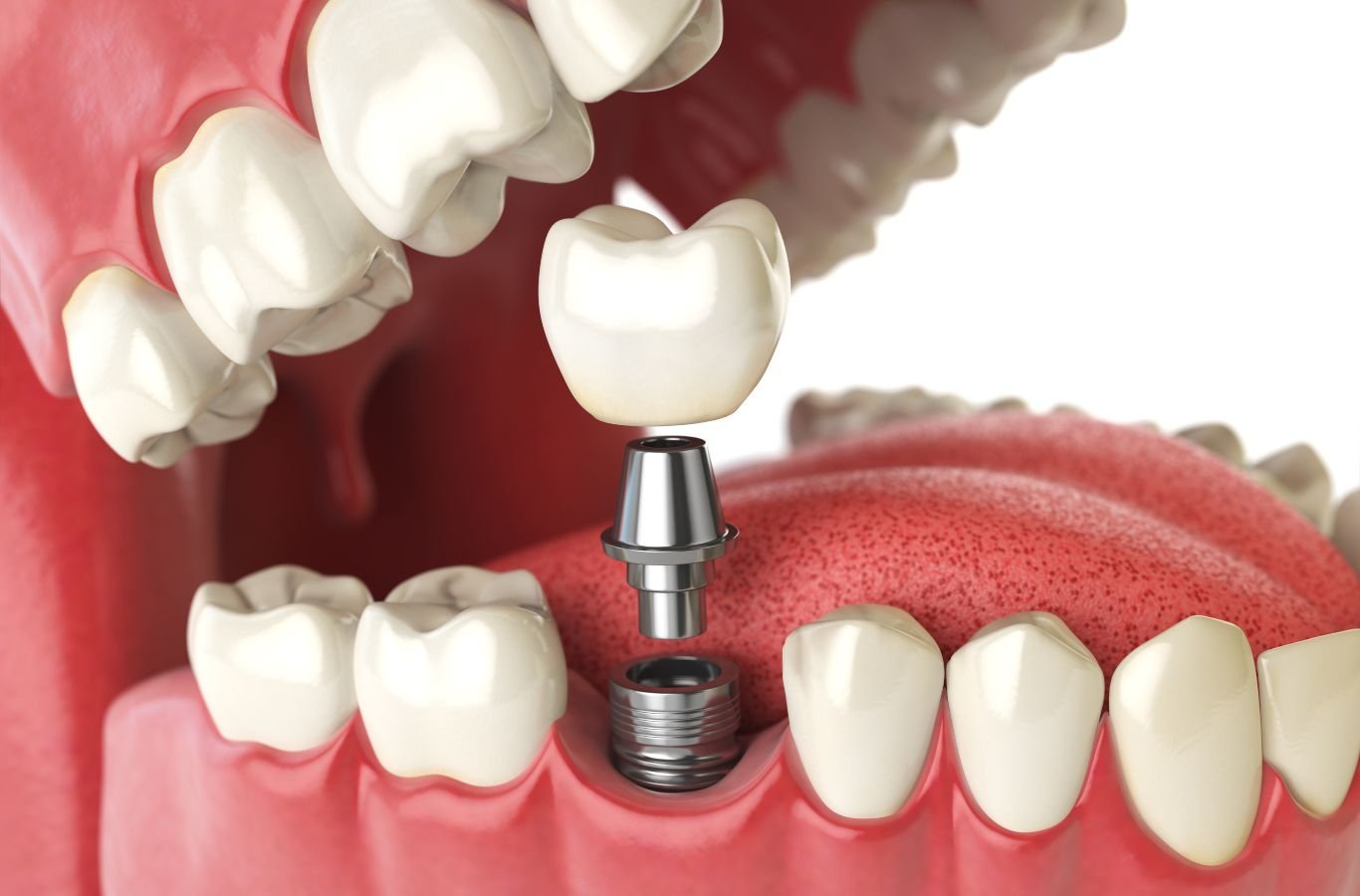 Single Dental Implants