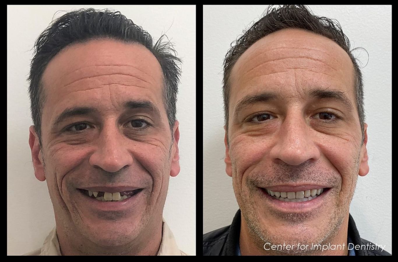 Benefits of Single Dental Implants in Gilroy, CA by Center For Implant Dentistry A Center For Implant Dentistry team member delivering single dental implants in Gilroy, CA, demonstrating the benefits of using a skilled local provider.