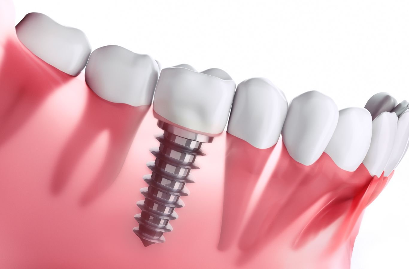 Single Dental Implants in Berkeley, CA by Center For Implant Dentistry A Center For Implant Dentistry employee providing expert single dental implant services in Berkeley, CA, showcasing professional tools and skills.