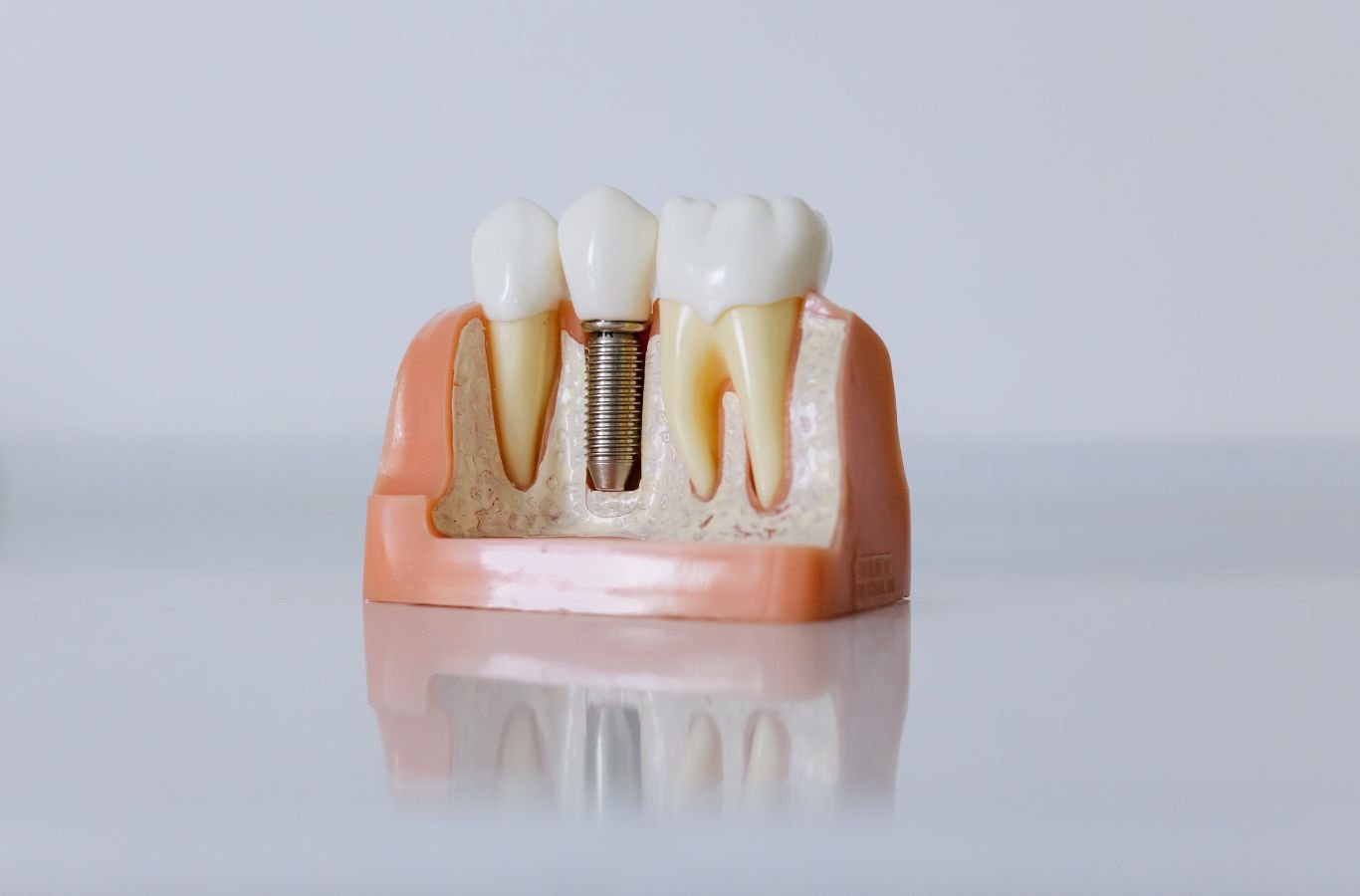 Single Dental Implants in Gilroy, CA by Center For Implant Dentistry A Center For Implant Dentistry employee providing expert single dental implant services in Gilroy, CA, showcasing professional tools and skills.