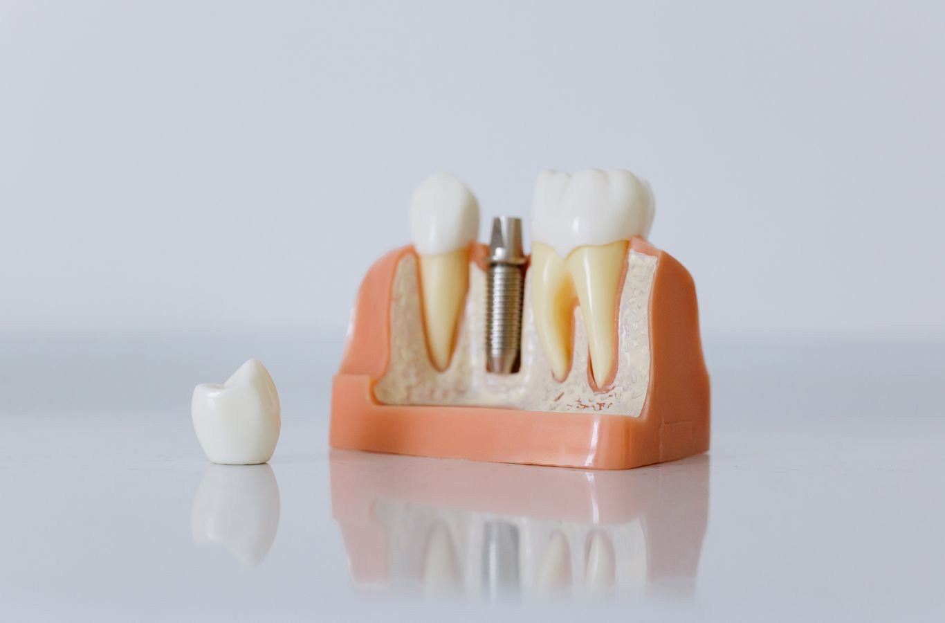 Single Dental Implants in Oakland, CA by Center For Implant Dentistry A Center For Implant Dentistry employee providing expert single dental implant services in Oakland, CA, showcasing professional tools and skills.