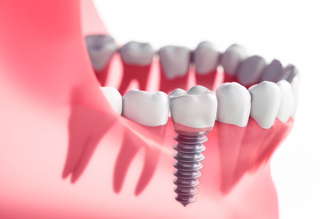 Single Dental Implants in Pleasanton, CA by Center For Implant Dentistry A Center For Implant Dentistry employee providing expert single dental implant services in Pleasanton, CA, showcasing professional tools and skills.