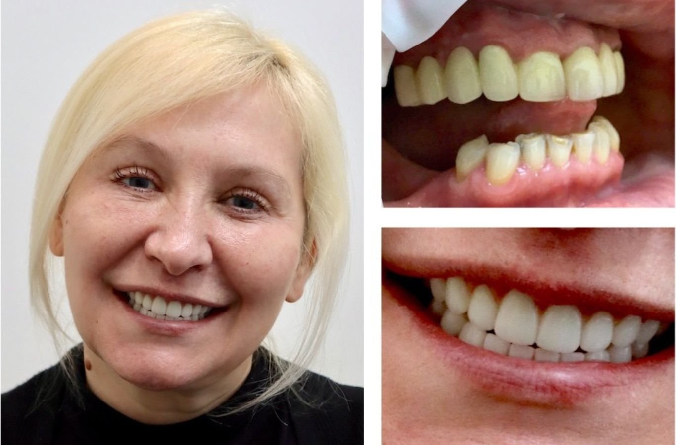 Why Choose Single Dental Implants in San Ramon, CA by Center For Implant Dentistry A Center For Implant Dentistry expert providing single dental implants in San Ramon, CA, showing why we’re a trusted provider in the area. Single Dental Implants near me.