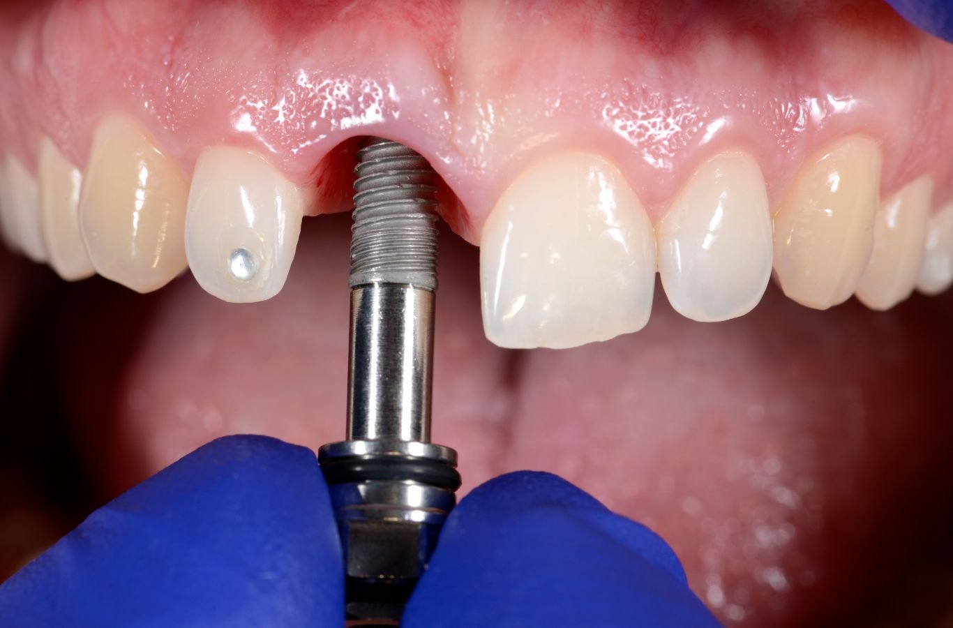 Single Dental Implants in Mill Valley, CA by Center For Implant Dentistry A Center For Implant Dentistry employee performing a single dental implant procedure in Mill Valley, CA, using precision tools to ensure lasting results.