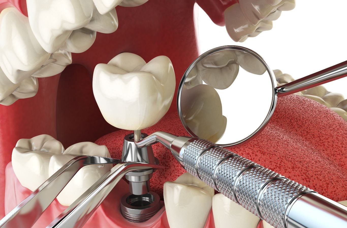 Single Dental Implants in Tracy, CA by Center For Implant Dentistry A Center For Implant Dentistry employee carefully placing a single dental implant in Tracy, CA, using advanced techniques and precision tools for long-lasting results.